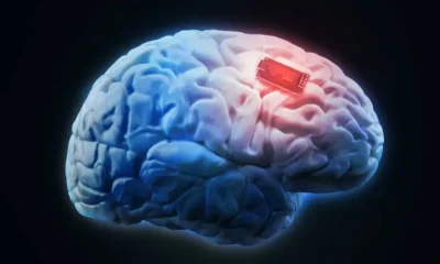 brain implant
